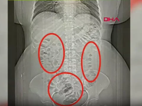 Midesinden 432 gram metamfetamin cikti uHLlODNr